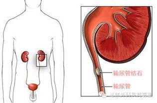 输尿管结石可以吃葫芦瓜,天然食疗的神奇功效